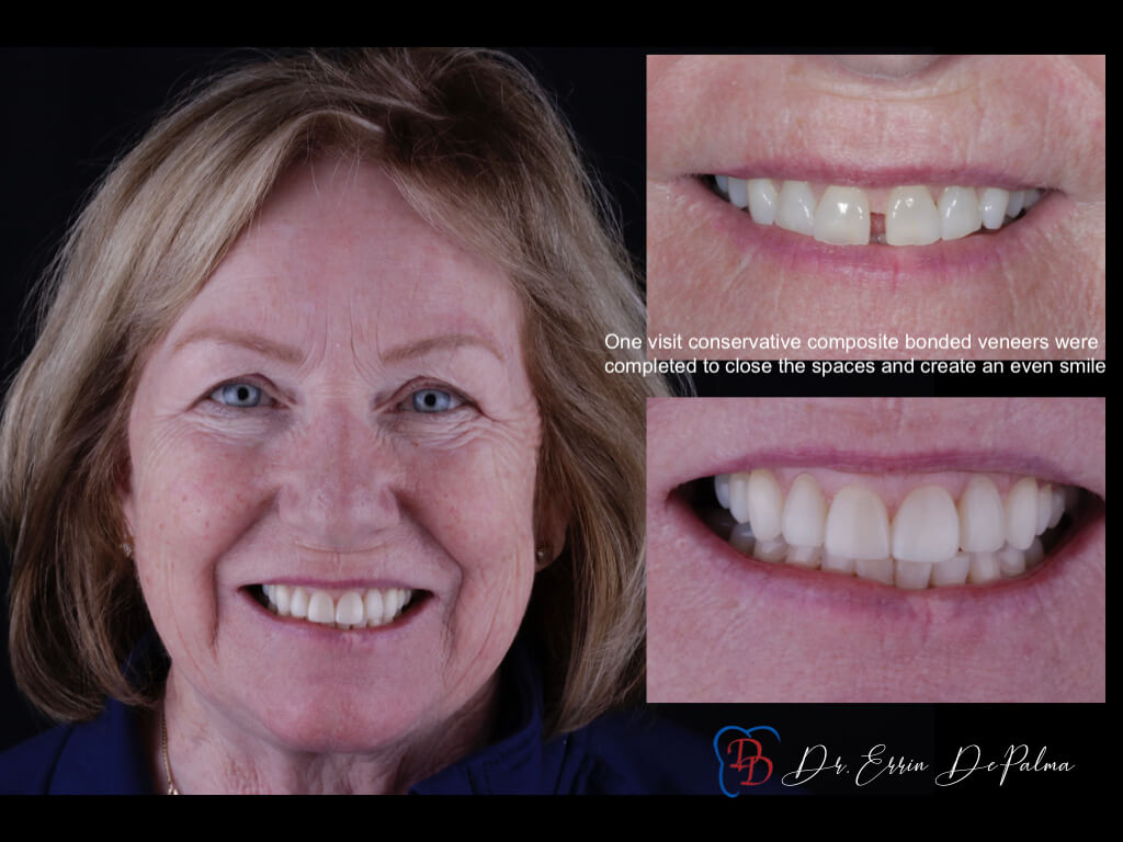 woman with smile makeover