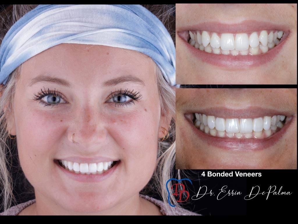 4 Bonded Veneers - Before and After Smile Makeover - Dr. Errin DePalma