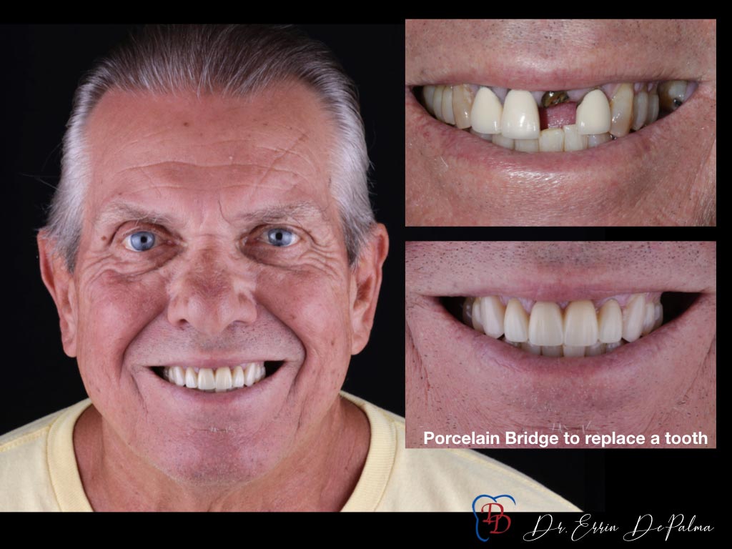 Porcelain Bridge to Replace a Tooth - Before and After Smile Makeover - Dr. Errin DePalma