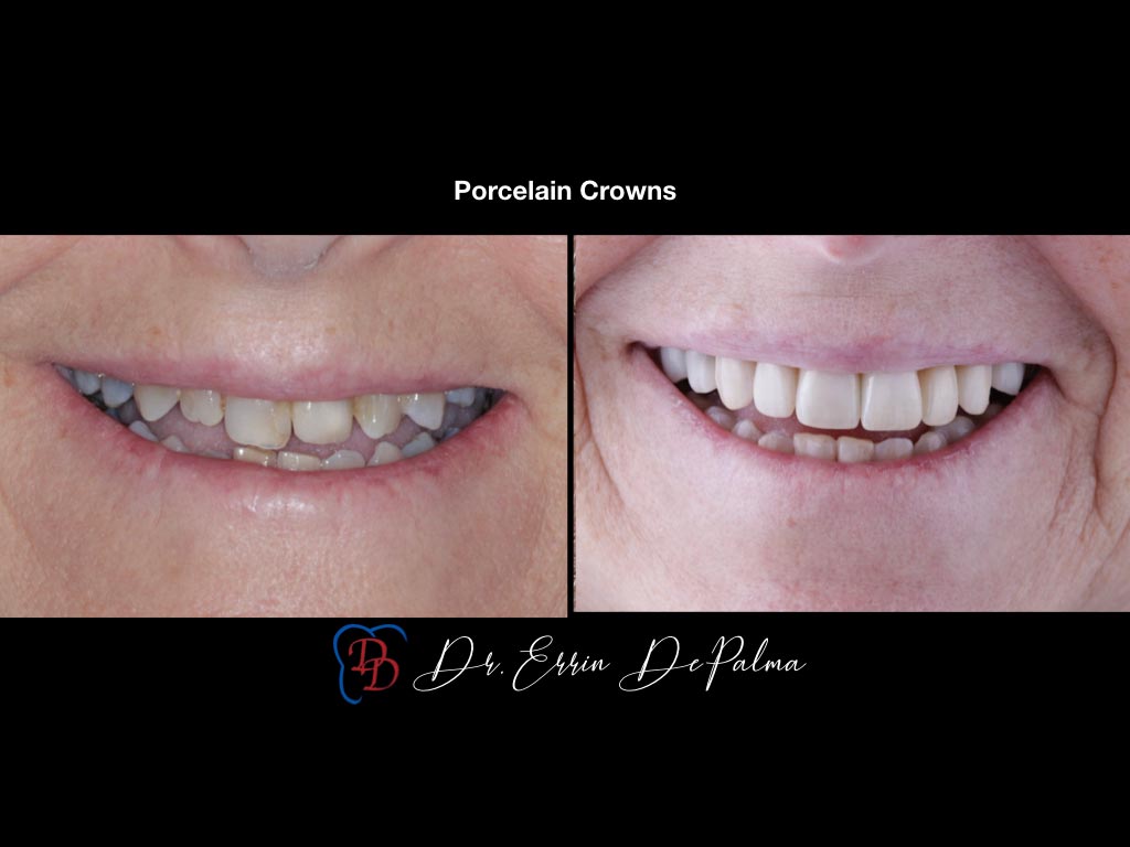 Porcelain Crowns - Before and After Smile Makeover - Dr. Errin DePalma