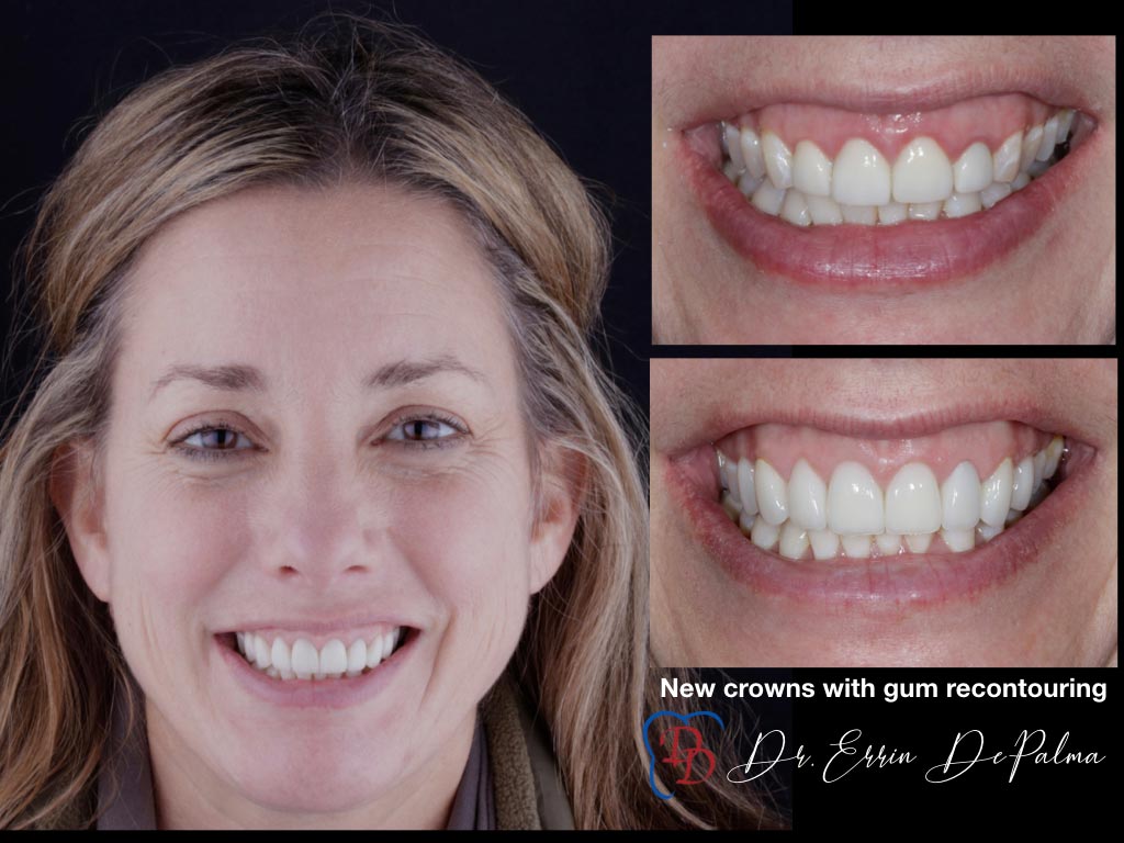 New Crowns with Gum Recontouring - Before and After Smile Makeover - Dr. Errin DePalma