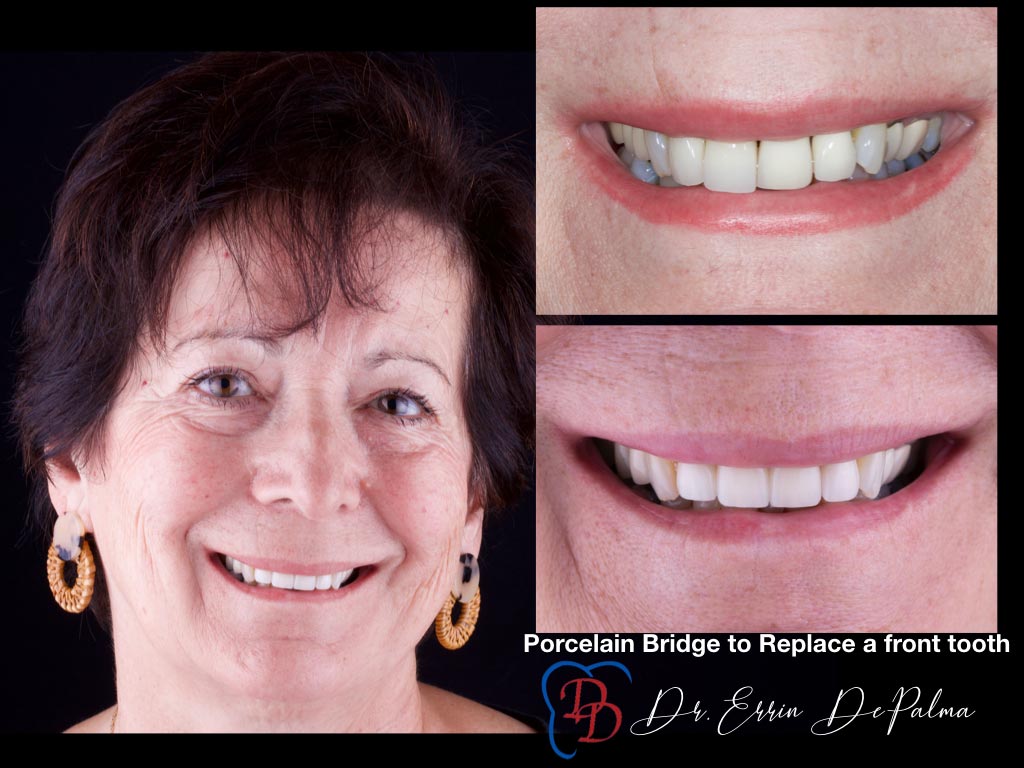 Porcelain Bridge to Replace a Front Tooth - Before and After Smile Makeover - Dr. Errin DePalma