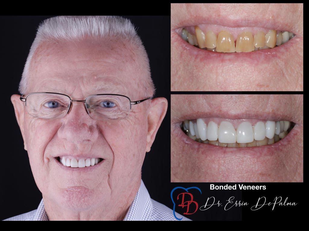 Bonded Veneers - Before and After Smile Makeover - Dr. Errin DePalma