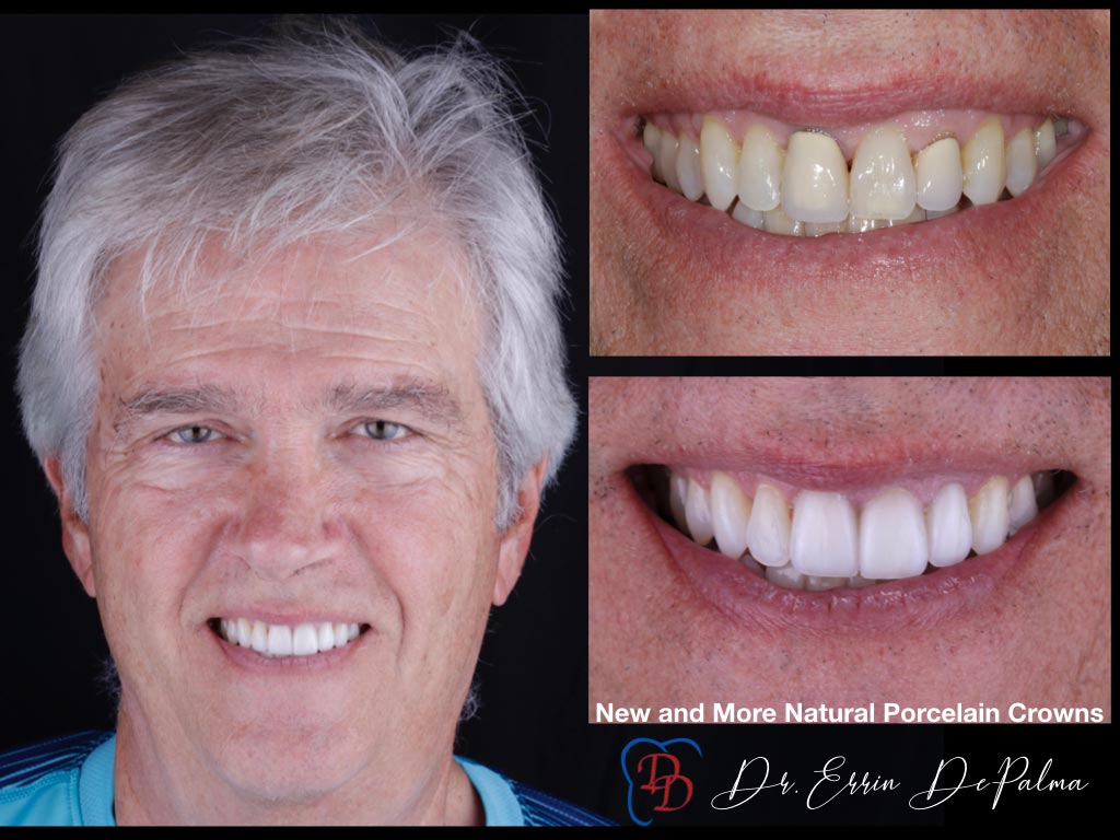 New More Natural Porcelain Crowns - Before and After Smile Makeover - Dr. Errin DePalma