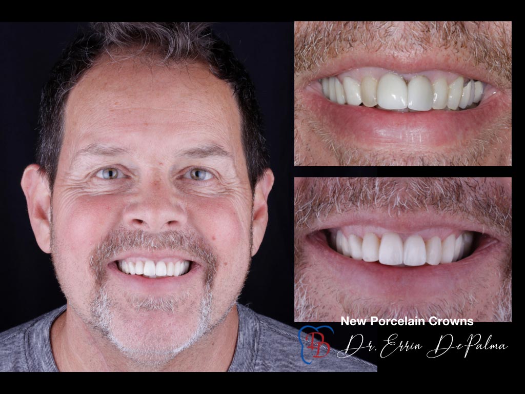 New Porcelain Crowns - Before and After Smile Makeover - Dr. Errin DePalma