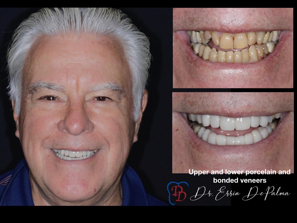 Upper and Lower Porcelain and Bonded Veneers - Before and After Smile Makeover - Dr. Errin DePalma